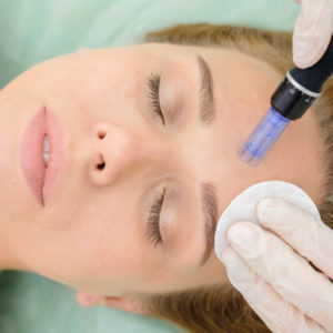 Microneedling